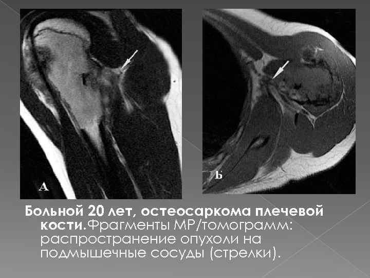 Больной 20 лет, остеосаркома плечевой кости. Фрагменты МР/томограмм: распространение опухоли на подмышечные сосуды (стрелки).