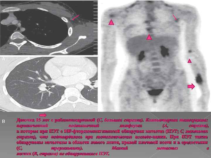 С А В Девочка 15 лет с рабдомиосаркомой (C, большая стрелка). Компьютерная томограмма: неувеличенный