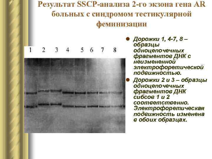 Результат SSCP-анализа 2 -го экзона гена AR больных с синдромом тестикулярной феминизации l Дорожки