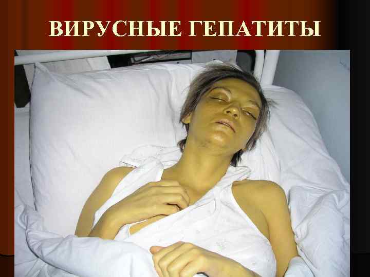 ВИРУСНЫЕ ГЕПАТИТЫ 