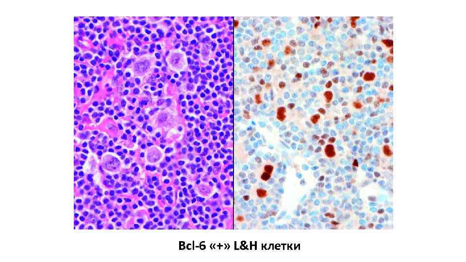 Bcl-6 «+» L&H клетки 