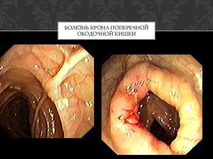 БОЛЕЗНЬ КРОНА ПОПЕРЕЧНОЙ ОБОДОЧНОЙ КИШКИ 