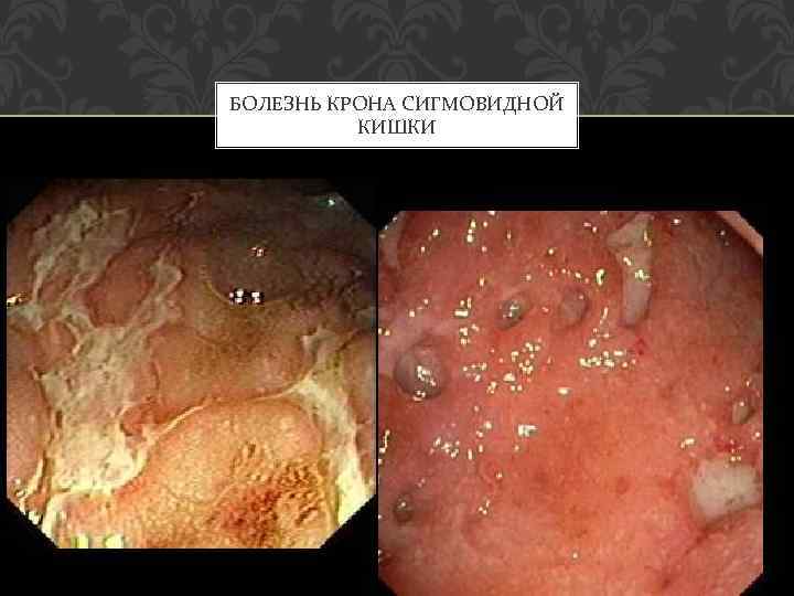 БОЛЕЗНЬ КРОНА СИГМОВИДНОЙ КИШКИ 