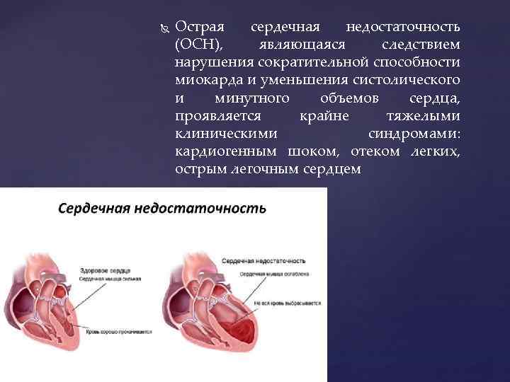 Острое сердце. Дилатации полостей сердца при сердечной недостаточности это. К острой сердечной недостаточности относятся. Острая сердечная недостаточность является следствием нарушения.