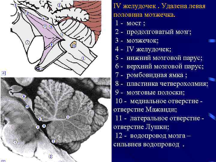 4 желудочек рисунок. Перешеек ромбовидного мозга анатомия. Нижний мозговой Парус 4 желудочка. Верхний мозговой Парус мозжечка. Нижний мозговой Парус мозжечка анатомия.