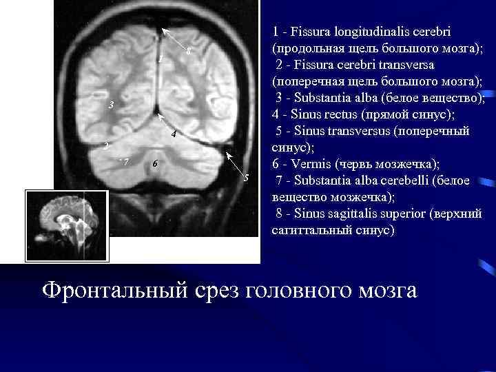 Гипоплазия правого поперечного синуса. Fissura longitudinalis. Продольная щель головного мозга. Продольная щель большого мозга.