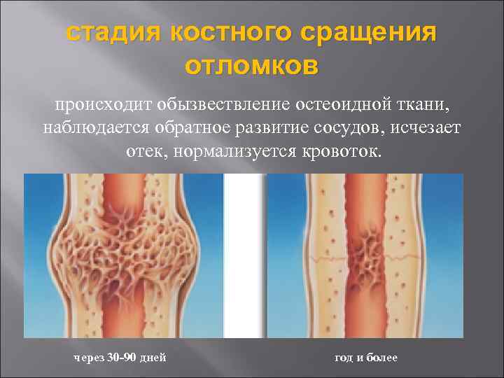 стадия костного сращения отломков происходит обызвествление остеоидной ткани, наблюдается обратное развитие сосудов, исчезает отек,