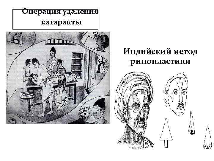 Операция удаления катаракты Индийский метод ринопластики 