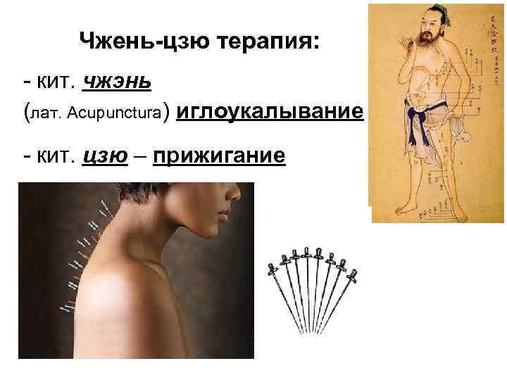 Чжень-цзю терапия: - кит. чжэнь (лат. Acupunctura) иглоукалывание - кит. цзю – прижигание 