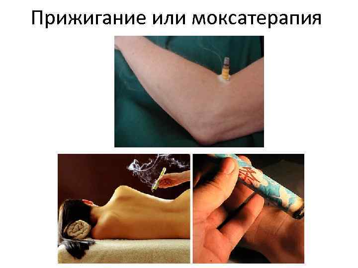 Прижигание или моксатерапия 