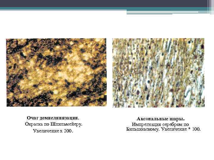 Очаг демиелинизации. Окраска по Шпильмейеру. Увеличение х 200. Аксональные шары. Импрегнация серебром по Бильшовскому.