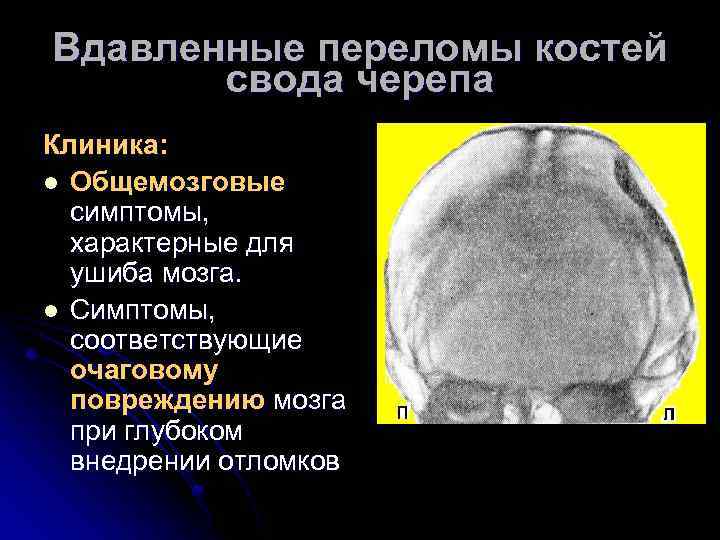 Вдавленные переломы костей свода черепа Клиника: l Общемозговые симптомы, характерные для ушиба мозга. l