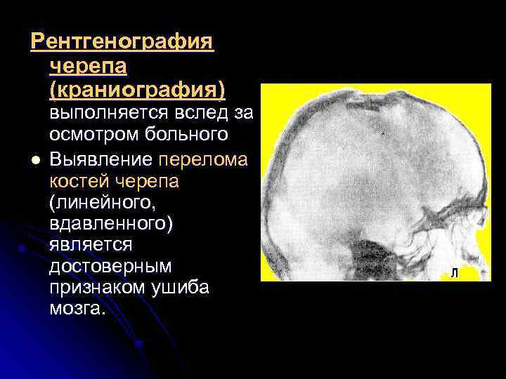 Рентгенография черепа (краниография) l выполняется вслед за осмотром больного Выявление перелома костей черепа (линейного,