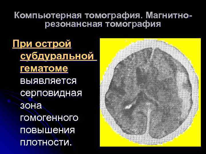 Компьютерная томография. Магнитнорезонансная томография При острой субдуральной гематоме выявляется серповидная зона гомогенного повышения плотности.