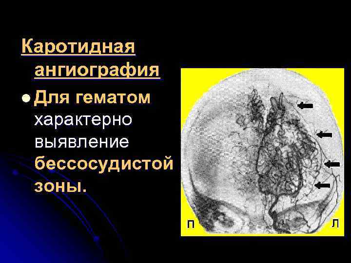 Каротидная ангиография l Для гематом характерно выявление бессосудистой зоны. 