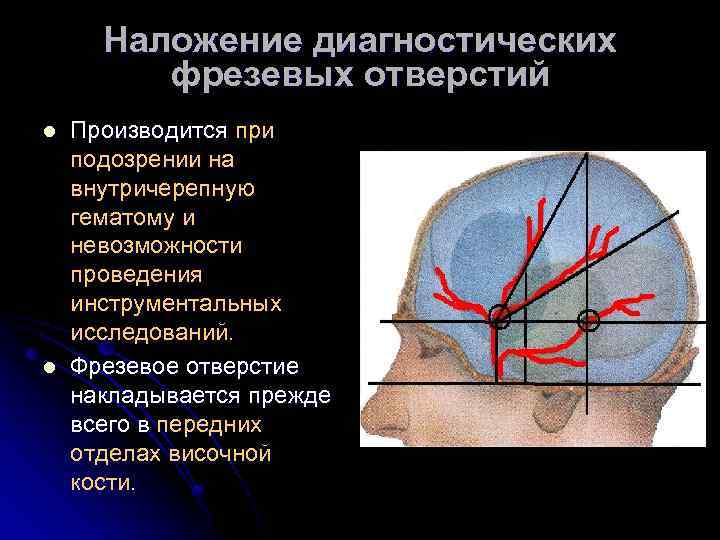 Наложение диагностических фрезевых отверстий l l Производится при подозрении на внутричерепную гематому и невозможности