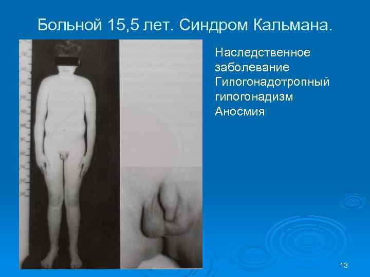 Больной 15, 5 лет. Синдром Кальмана. Наследственное заболевание Гипогонадотропный гипогонадизм Аносмия 13 