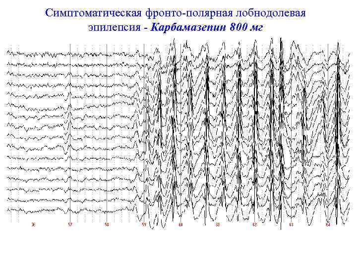 Симптоматическая фронто-полярная лобнодолевая эпилепсия - Карбамазепин 800 мг 