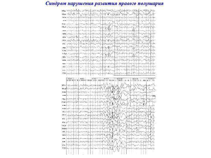 Синдром нарушения развития правого полушария 