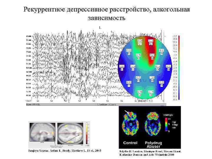 Рекуррентное депрессивное расстройство, алкогольная зависимость 
