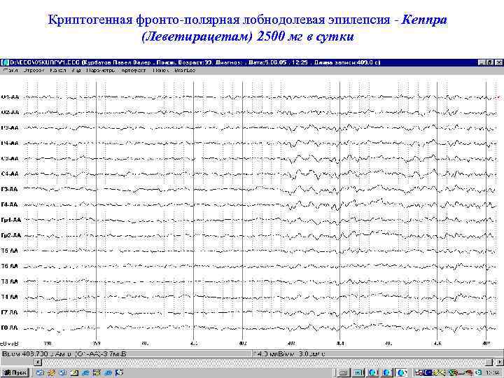 Криптогенная фронто-полярная лобнодолевая эпилепсия - Кеппра (Леветирацетам) 2500 мг в сутки 