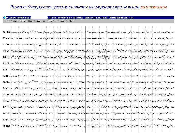 Речевая диспраксия, резистентная к вальпроату при лечении ламикталом 