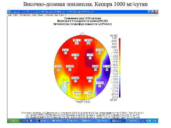 Височно-долевая эпилепсия. Кеппра 1000 мг/сутки 