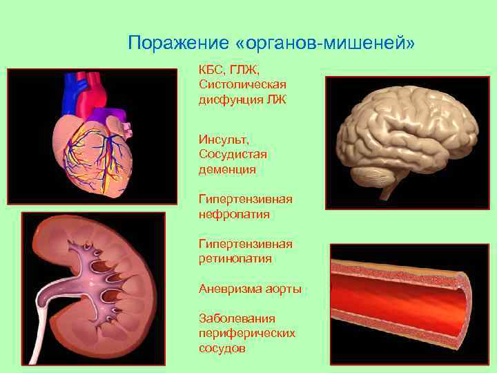 Поражение «органов-мишеней» КБС, ГЛЖ, Систолическая дисфунция ЛЖ Инсульт, Сосудистая деменция Гипертензивная нефропатия Гипертензивная ретинопатия