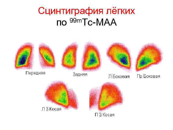 Сцинтиграмма является изображением