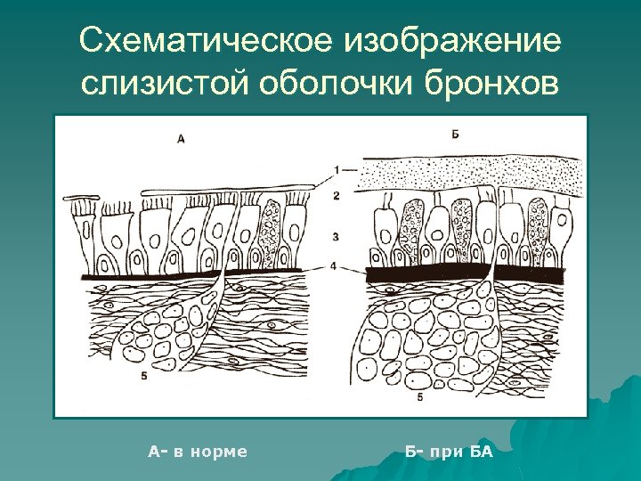 Схематическое изображение слизистой оболочки бронхов А- в норме Б- при БА 