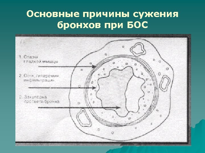 Основные причины сужения бронхов при БОС 