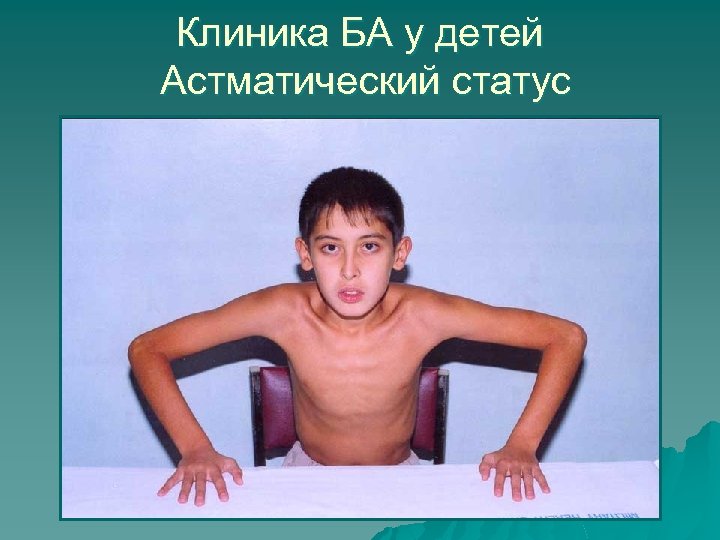 Клиника БА у детей Астматический статус 