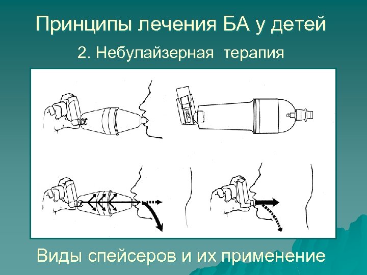 Принципы лечения БА у детей 2. Небулайзерная терапия Виды спейсеров и их применение 