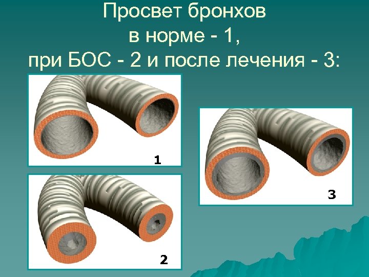 Просвет бронхов. Прослеживаются просветы бронхов. Просвет бронхов положительный. Просвет бронхов увеличивается.