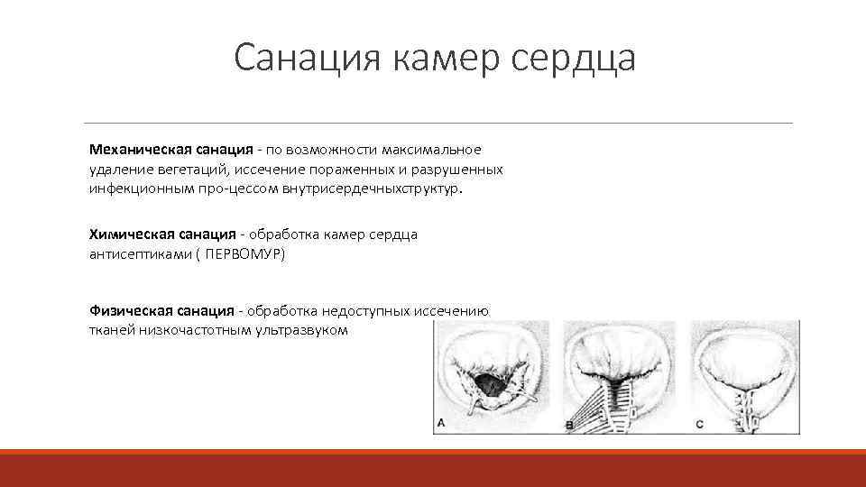 Санация камер сердца Механическая санация - по возможности максимальное удаление вегетаций, иссечение пораженных и