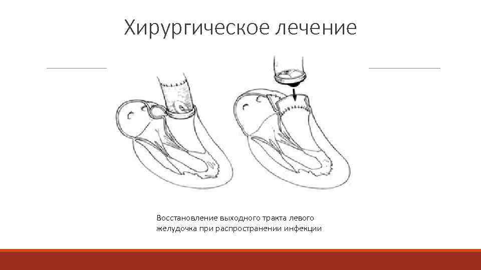 Хирургическое лечение Восстановление выходного тракта левого желудочка при распространении инфекции 