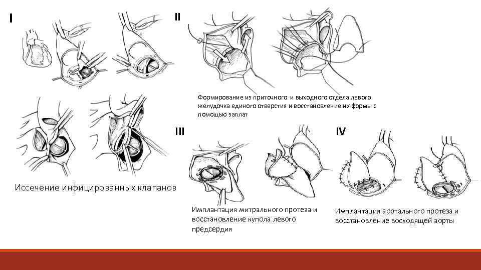 I II Формирование из приточного и выходного отдела левого желудочка единого отверстия и восстановление