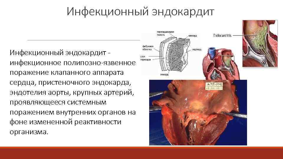 Инфекционный эндокардит инфекционное полипозно язвенное поражение клапанного аппарата сердца, пристеночного эндокарда, эндотелия аорты, крупных