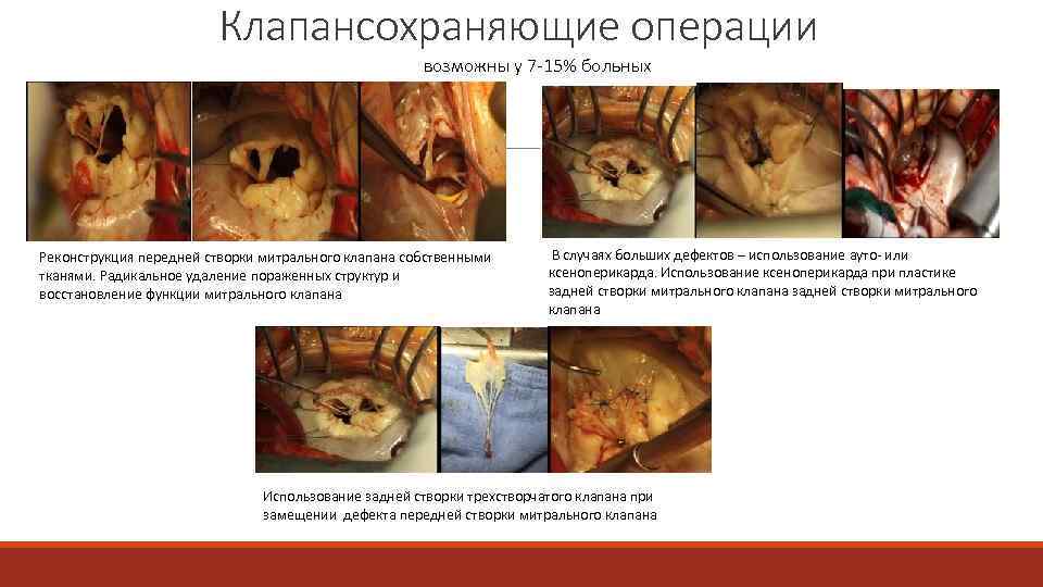 Клапансохраняющие операции возможны у 7 15% больных Реконструкция передней створки митрального клапана собственными тканями.