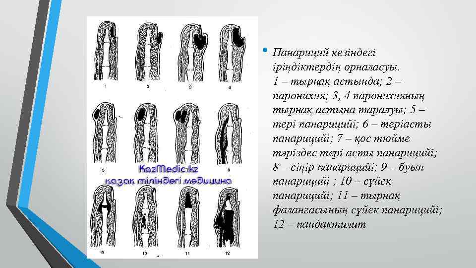  • Панариций кезіндегі іріңдіктердің орналасуы. 1 – тырнақ астында; 2 – паронихия; 3,