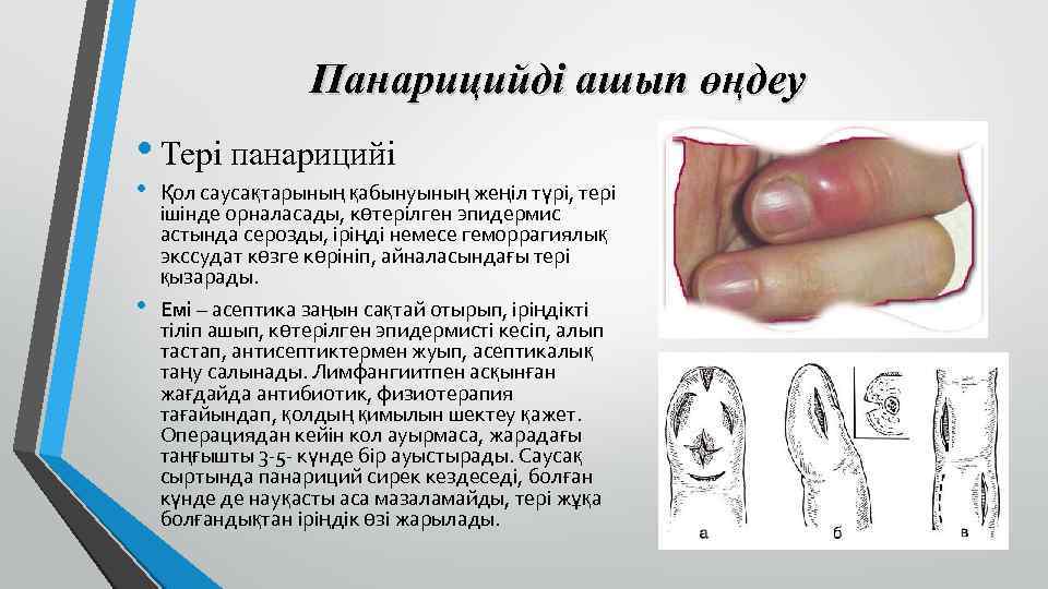 Панарицийді ашып өңдеу • Тері панарицийі • • Қол саусақтарының қабынуының жеңіл түрі, тері