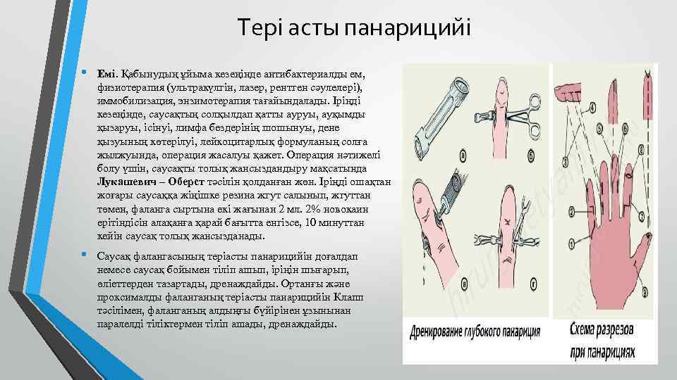 Тері асты панарицийі • Емі. Қабынудың ұйыма кезеңінде антибактериалды ем, физиотерапия (ультракүлгін, лазер, рентген