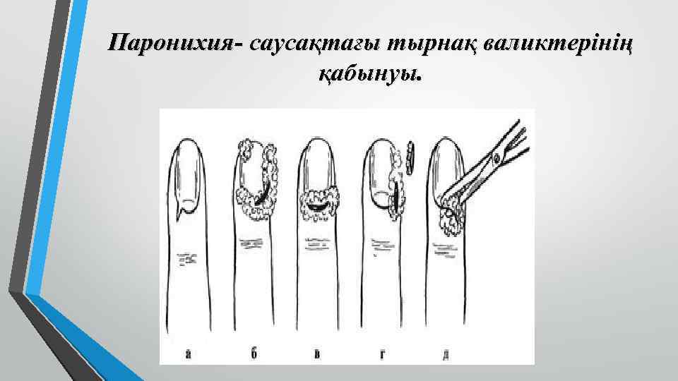 Паронихия- саусақтағы тырнақ валиктерінің қабынуы. 