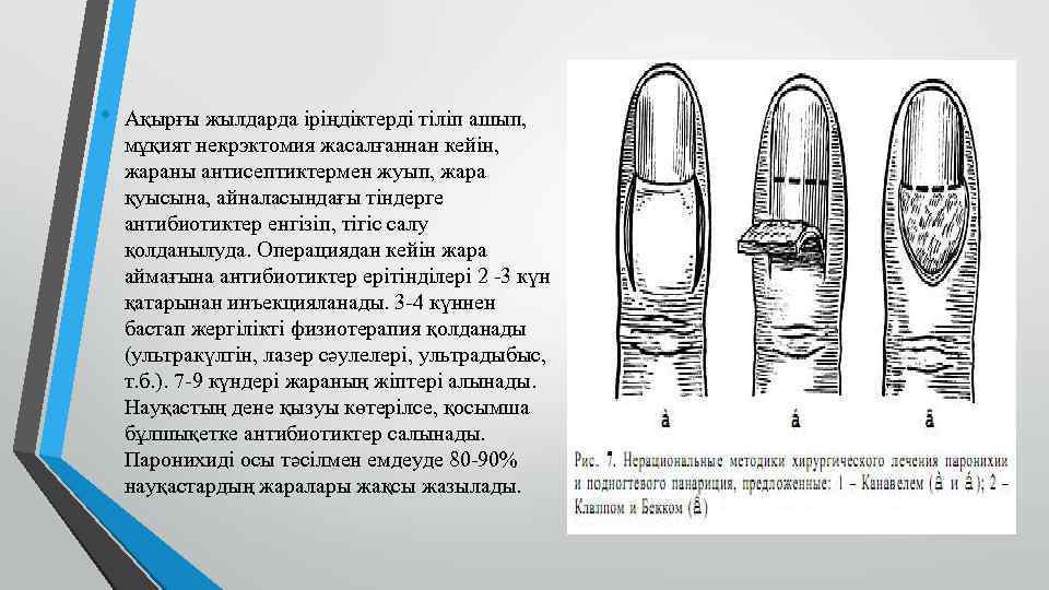  • Ақырғы жылдарда іріңдіктерді тіліп ашып, мұқият некрэктомия жасалғаннан кейін, жараны антисептиктермен жуып,