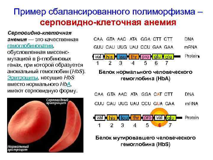 Пример сбалансированного полиморфизма – серповидно-клеточная анемия Серповидно-клеточная анемия — это качественная гемоглобинопатия, обусловленная миссенсмутацией