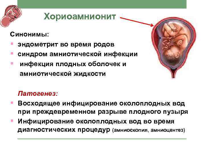 Хориоамнионит Синонимы: § эндометрит во время родов § синдром амниотической инфекции § инфекция плодных
