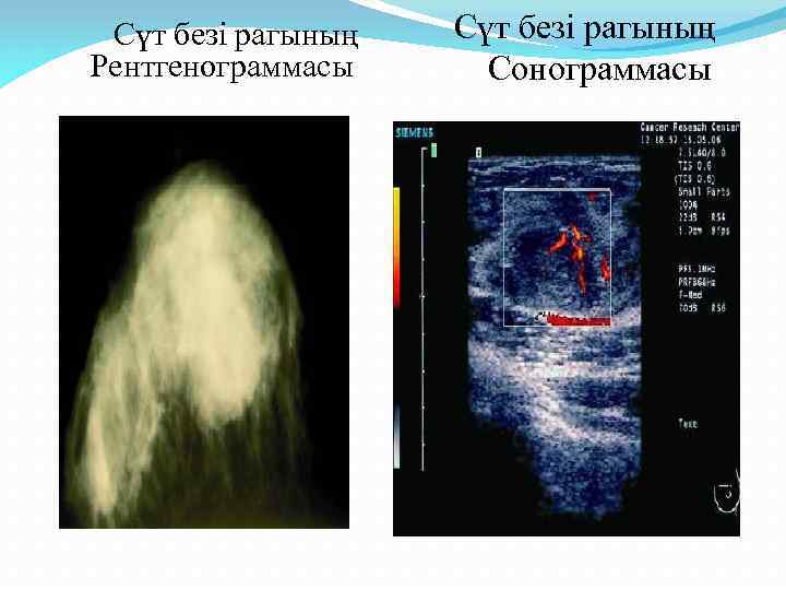 Сүт безі рагының Рентгенограммасы Сүт безі рагының Сонограммасы 