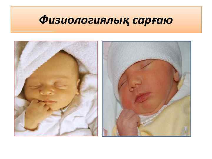 Физиологиялық сарғаю 