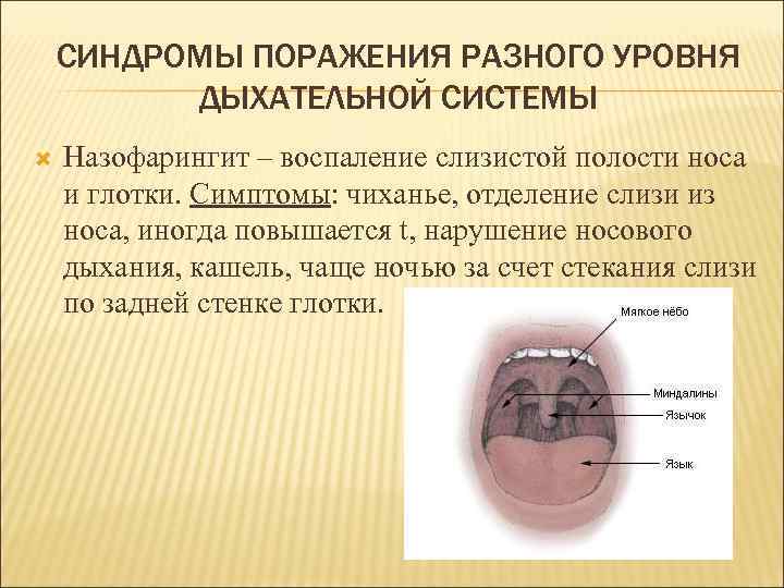 Назофарингит симптомы. Синдромы поражения разных уровней дыхательной системы назофарингит. Семиотика и синдромы поражений органов дыхания. Синдром назофарингита. Синдромы при назофарингите.