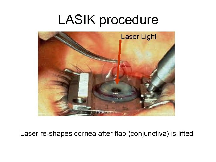 LASIK procedure Laser Light Laser re-shapes cornea after flap (conjunctiva) is lifted 